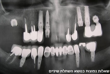 השתלת שיניים - שאלות נפוצות