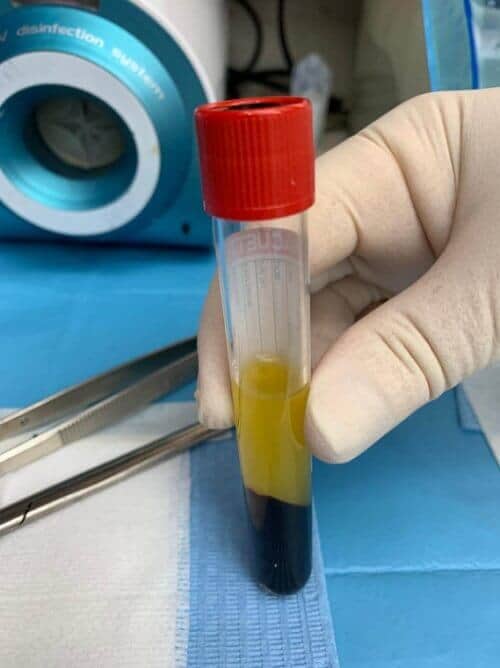 שיטת PRF- Platelets Rich Fibrin