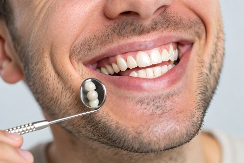 מה עושים אחרי השתלת שיניים